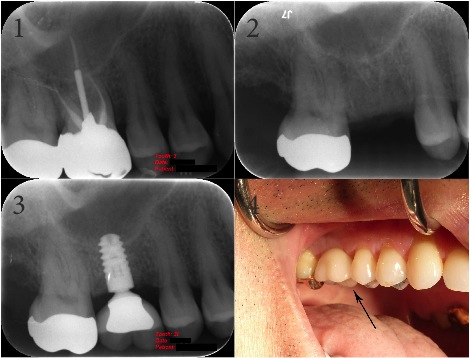 Endodontic & Implantology Associates Bone Grafting and Dental Implant Case Study: Case A