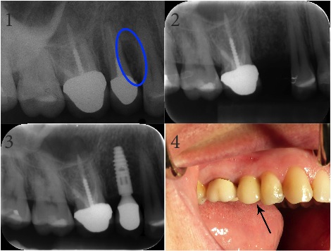 Endodontic & Implantology Associates Bone Grafting and Dental Implant Case Study: Case B