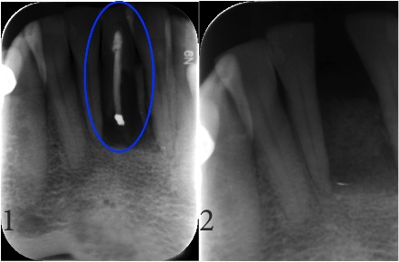 Endodontic & Implantology Associates Bone Grafting Case Study: Case C